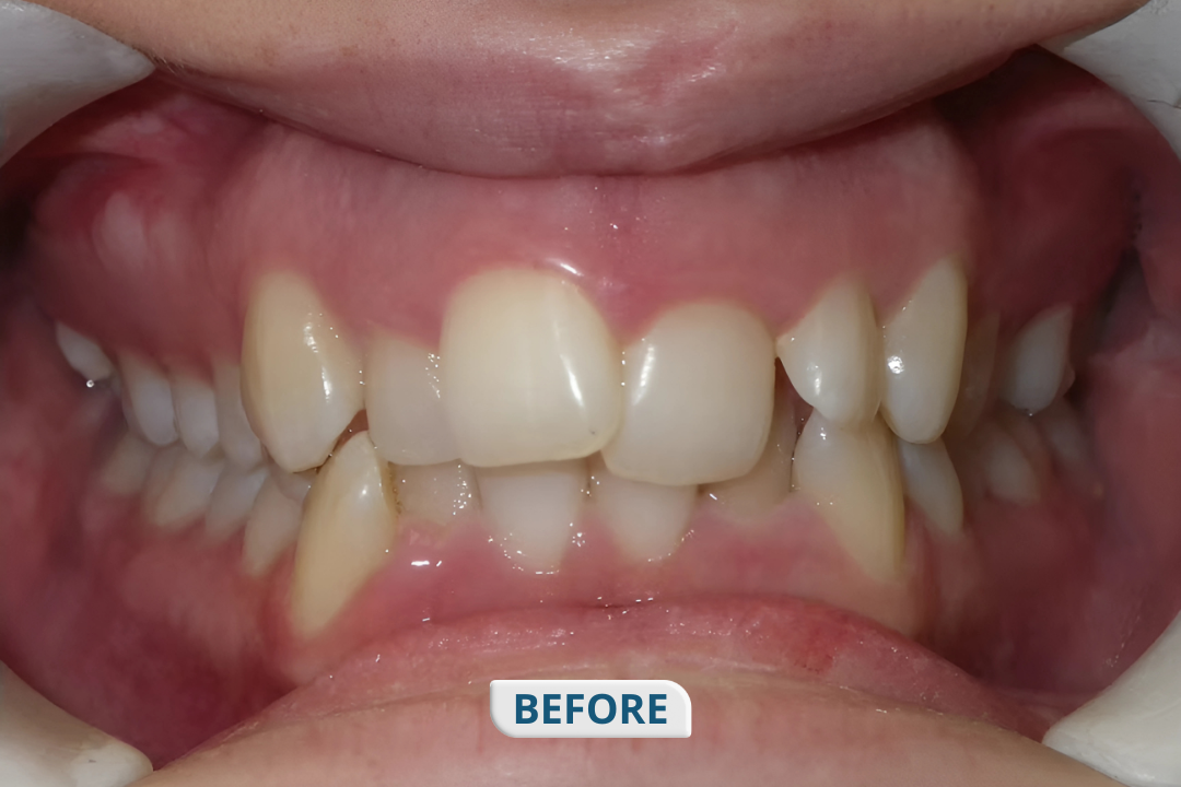 Before treatment at Namira Oro Dental Care